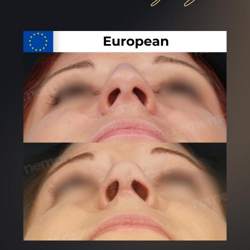 Perfiloplastia Foto antes/después